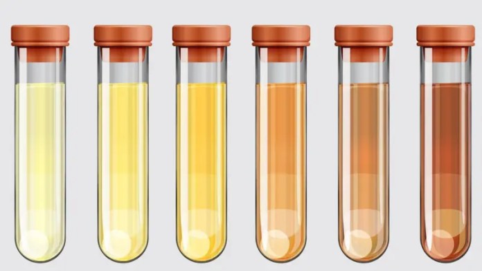 GETTY IMAGES Pie de foto,La orina puede adquirir tonos diferentes.